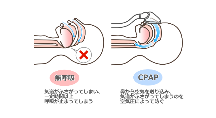 東京の歯医者、高輪歯科の睡眠歯科医療サービス、オーラルスリープ™のCPAP療法